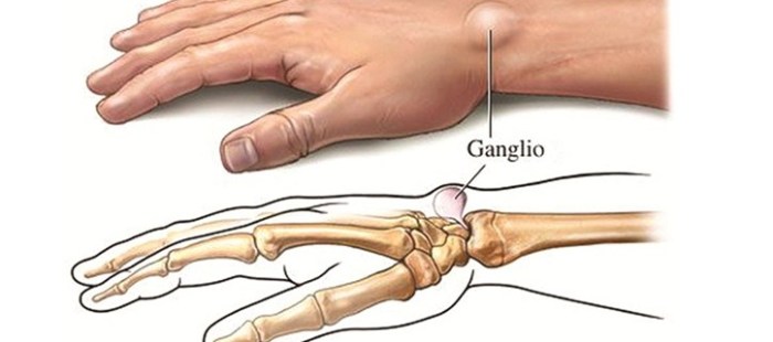 cisti-polso1-724x321