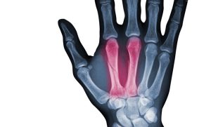 frattura-falange-mano-1024x620