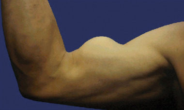 lesione-bicipte-e1555175057702