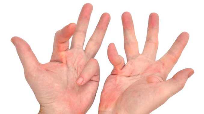 morbo-di-Dupuytren-678x381